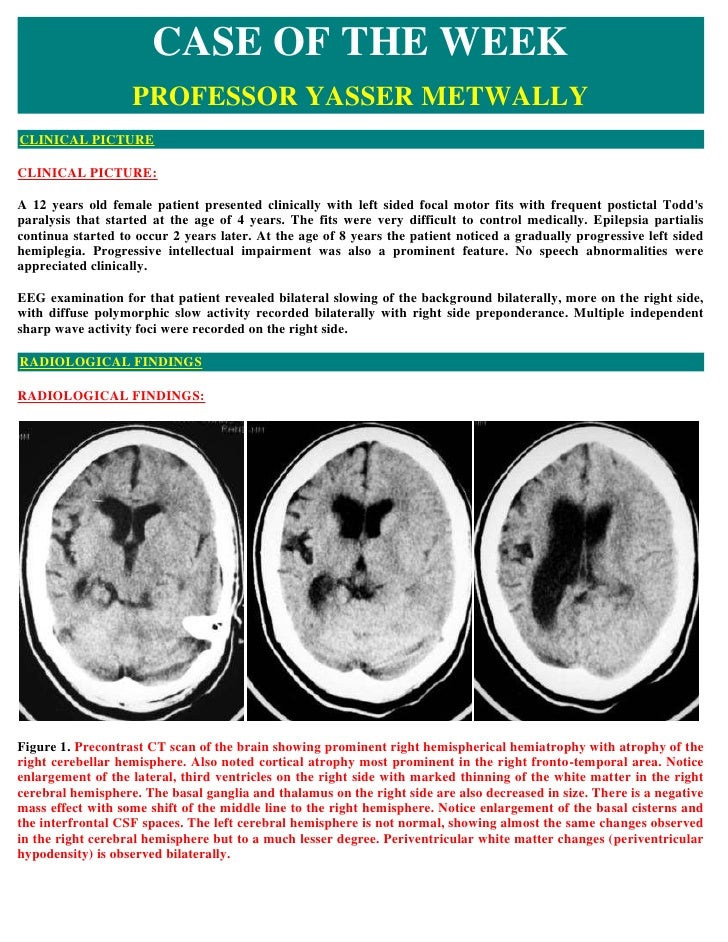 The documented historical research for rasmussens encephalitis hemispherectomy